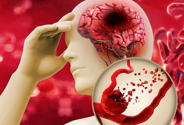 rối loạn nhịp tim gây đột quỵ