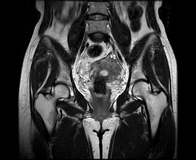 Vai trò chụp MRI vùng tiểu khung