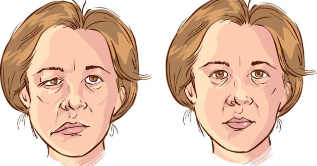 Méo một phần mặt hoặc nửa khuôn mặt là triệu chứng tai biến mạch máu não