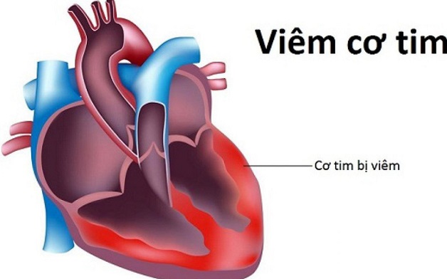 Đau ngực phải khó thở cảnh báo bệnh gì?