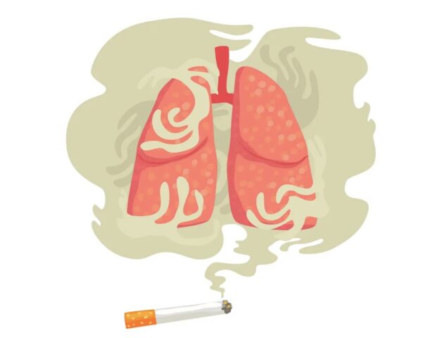 Tìm hiểu những dấu hiệu ung thư phổi ở giai đoạn đầu