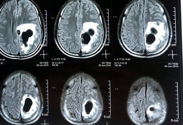 Những trường hợp chỉ định chụp MRI sọ não