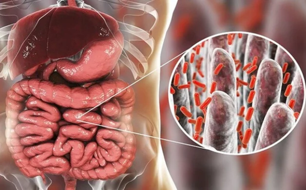 Viêm đường ruột cấp tính có thể được gây ra bởi các vi khuẩn