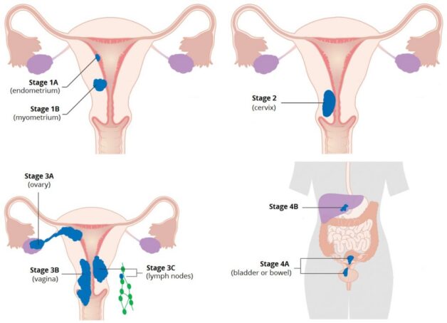 Tìm hiểu bệnh ung thư buồng trứng giai đoạn di căn ổ bụng