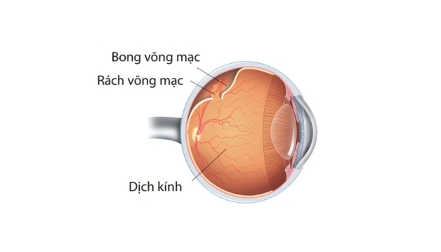 sau phẫu thuật bong võng mạc như thế nào