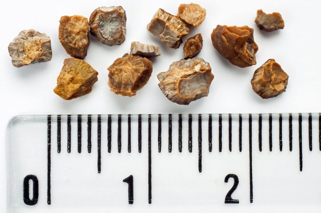 siêu âm sỏi thận