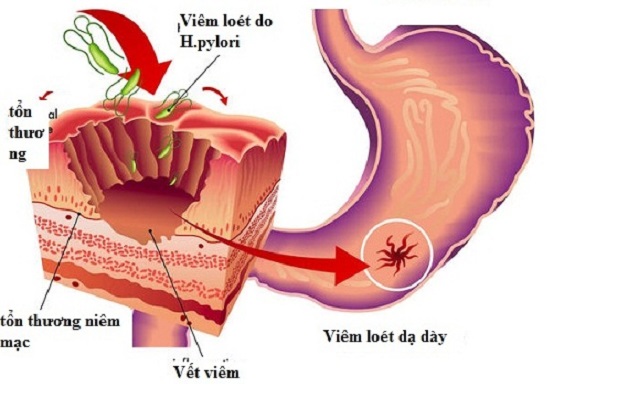 Điều trị sinh lý bệnh loét dạ dày tá tràng