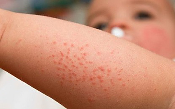 sốt xuất huyết ở trẻ nhỏ