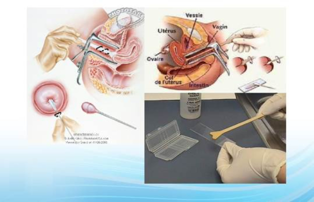 Mô tả quy trình thực hiện xét nghiệm Pap Smear