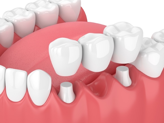 Thiếu mầm răng vĩnh viễn