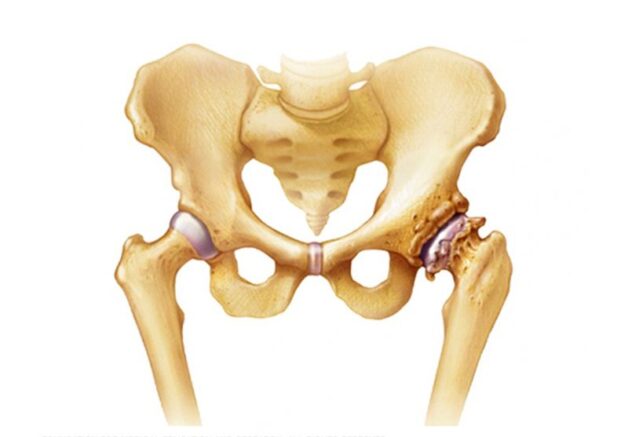 Khớp háng thoái hóa có thể gây ra các cơn đau, nhức, gây ảnh hưởng trực tiếp đến cuộc sống thường ngày của bệnh nhân
