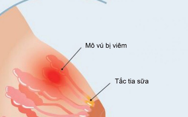 Tắc tia sữa sau sinh là tình trạng rất phổ biến.