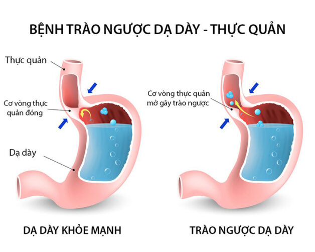 Khi dạ dày bị đau bụng trào ngược