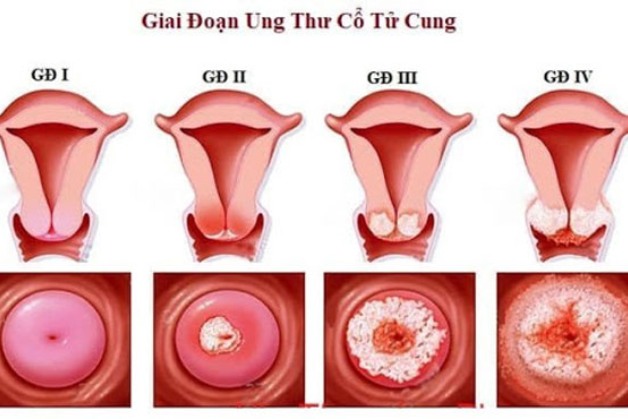 tầm soát ung thư cổ tử cung