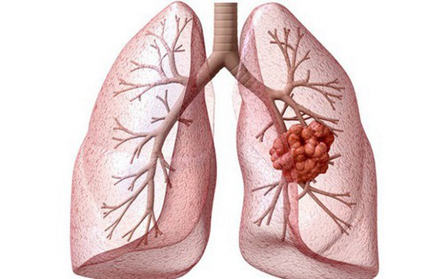 xét nghiệm tầm soát ung thư phổi