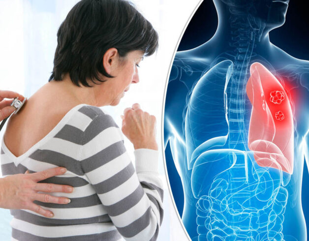 Bệnh ung thư phổi giai đoạn đầu dạng không tế bào nhỏ