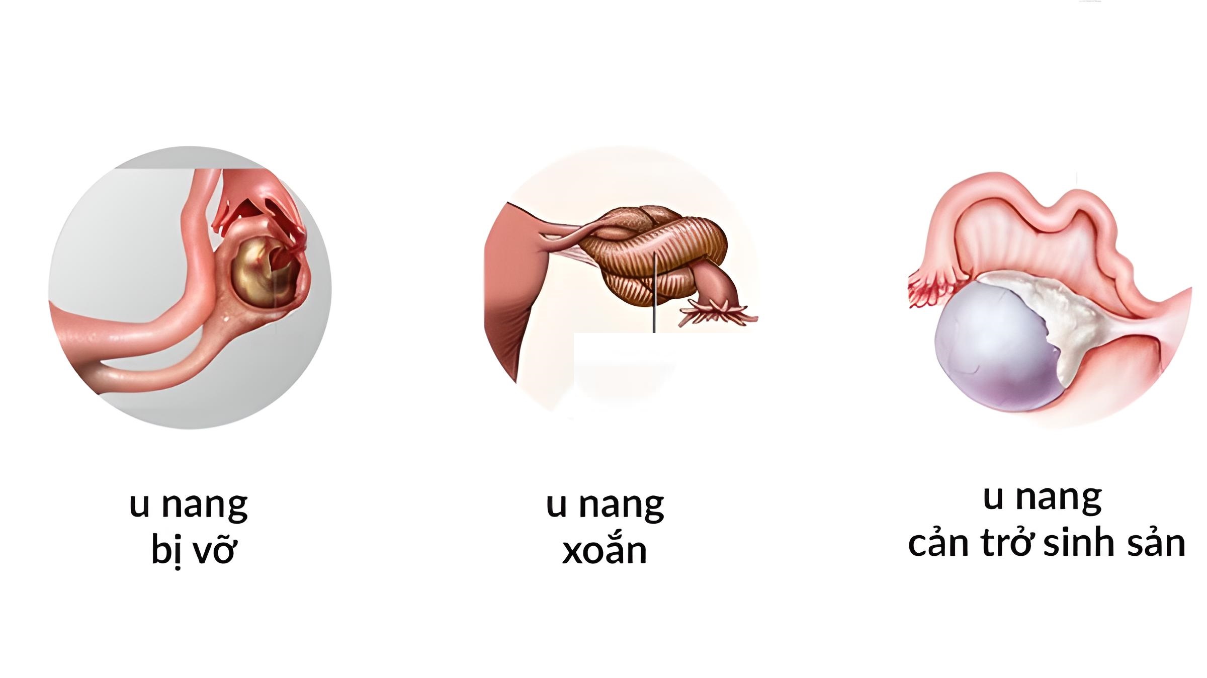 U nang buồng trứng có thể phát triển và gây ra những biến chứng nguy hiểm nếu không được xử trí sớm