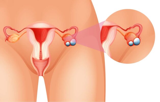 Cách điều trị ung thư buồng trứng ở giai đoạn đầu