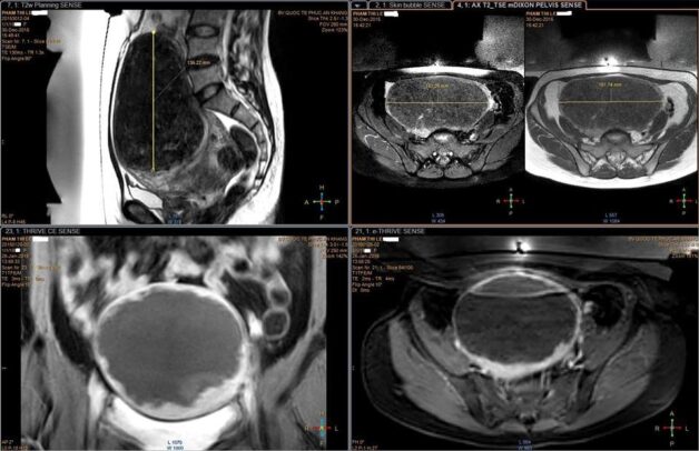 Hình ảnh chụp MRI tiểu khung