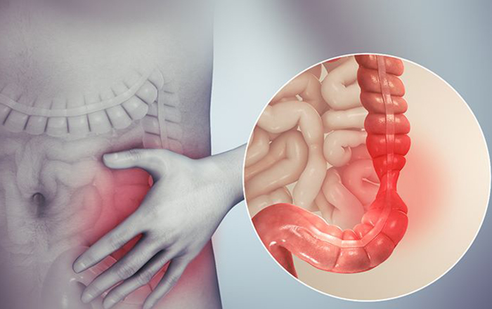 đại tràng co thắt thể táo bón là gì