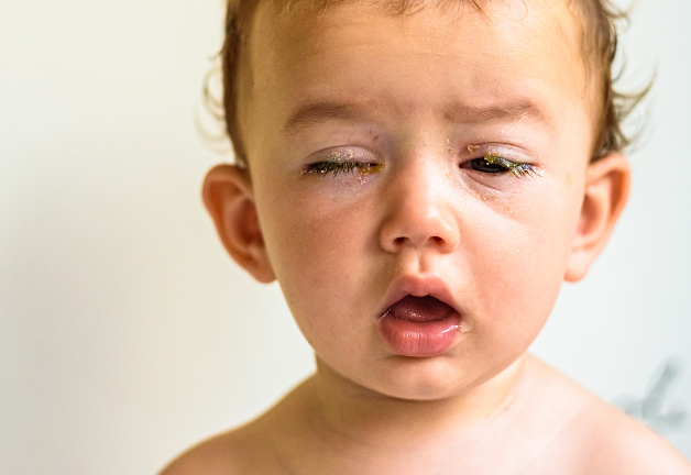 Viêm kết mạc là bệnh lý liên quan đến mắt phổ biến, còn gọi là đau mắt đỏ