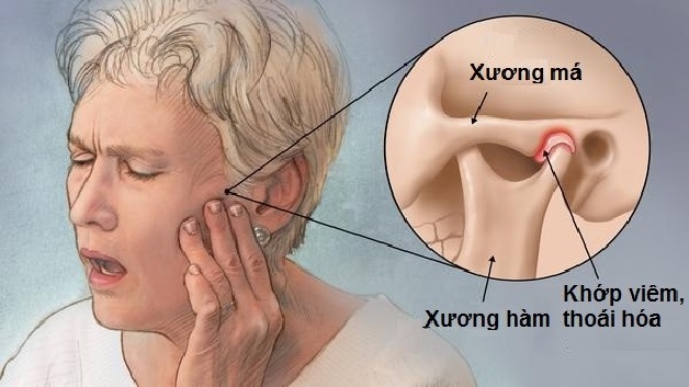 Viêm khớp thái dương hàm là tình trạng rối loạn chức năng khớp
