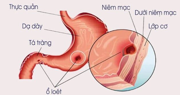 Loét dạ dày khác viêm dạ dày do tổn thương dưới lớp niêm mạc dạ dày