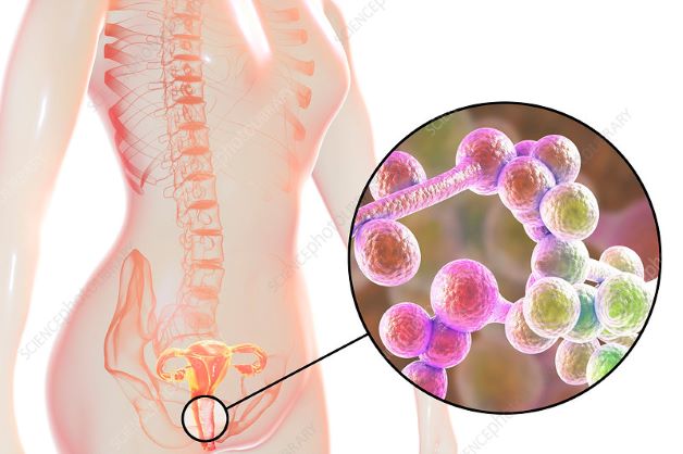 Viêm âm đạo do nấm Candida gây ra