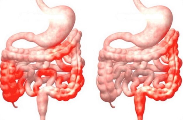 Viêm ruột cấp tính có thể xảy ra ở bất kỳ phần nào của đường ruột