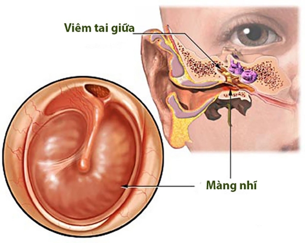 viêm tai giữa mạn tính