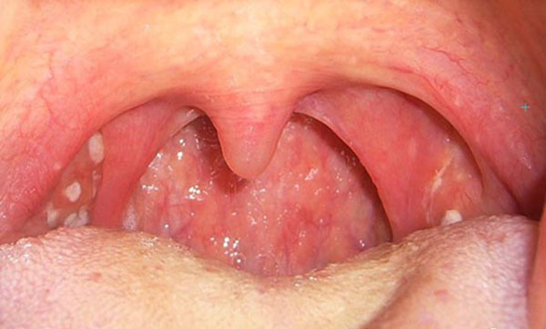 Triệu chứng bệnh ung thư vòm họng
