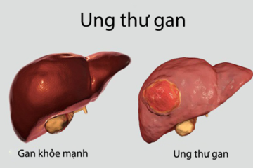Ung thư gan có bao nhiêu giai đoạn