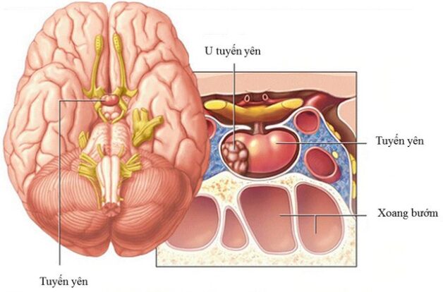 Dấu hiệu u tuyến yên với mỗi người sẽ có mức độ khác nhau