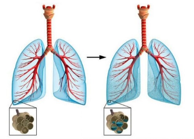 Điều trị suy tim cấp 