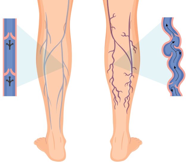 Viêm dây thần kinh là bệnh thường gặp