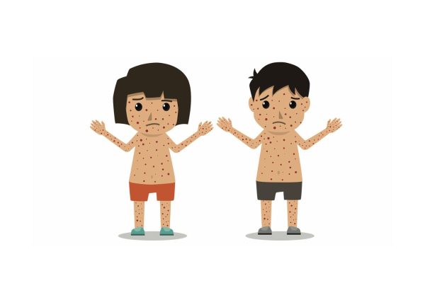 Sởi là bệnh truyền nhiễm cấp tính thường lây truyền qua đường hô hấp ở cả người lớn và trẻ nhỏ