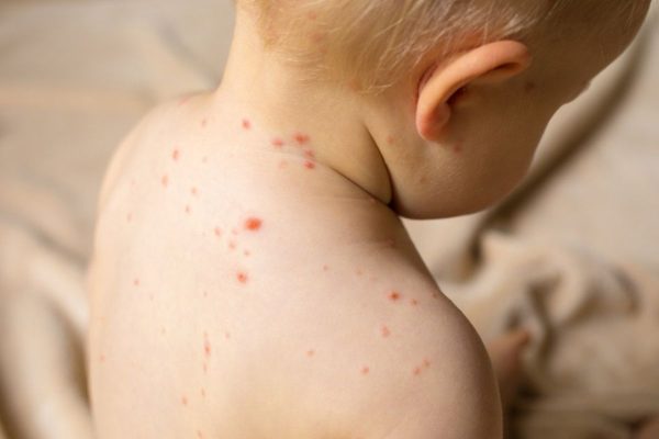 Trẻ mắc sởi thường có biểu hiện sốt cao, ho khán, khó thở, phát ban...