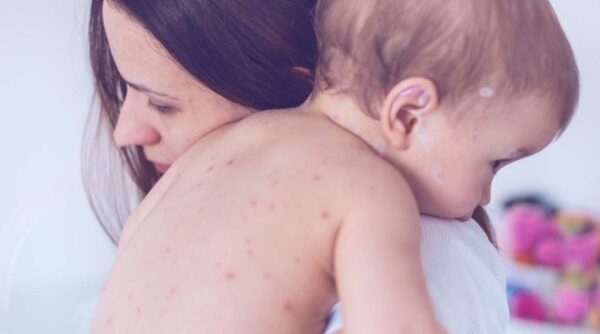 Trẻ ít khi bị mắc lại thủy đậu lần 2