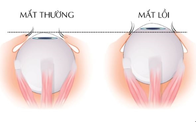 bị lồi mắt là gì