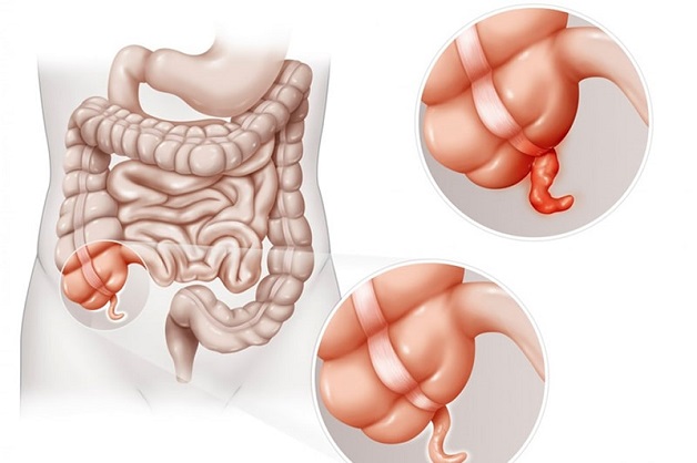 Đau ruột thừa là phần ruột bị viêm sưng đột ngột
