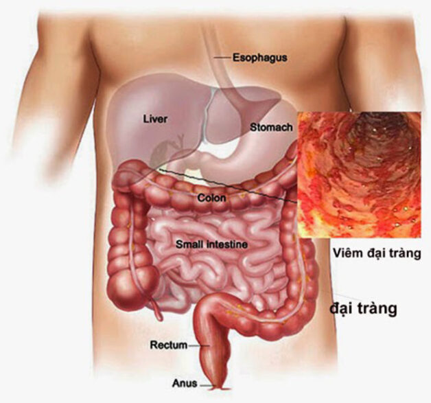 Viêm đại tràng có nhiều triệu chứng trong đó có xì hơi