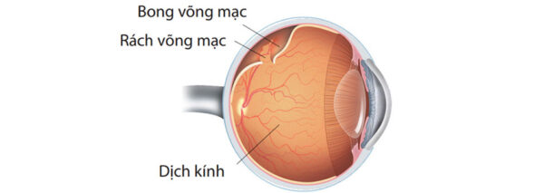 Rách võng mạc là gì?