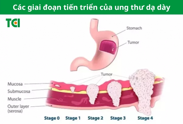 Các giai đoạn của ung thư dạ dày