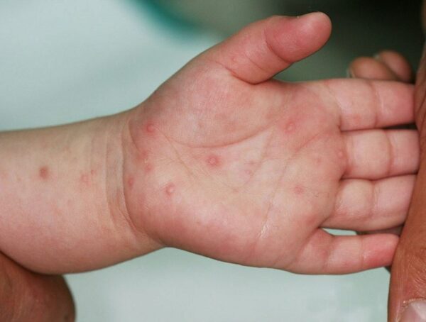 cách trị bệnh tay chân miệng tại nhà