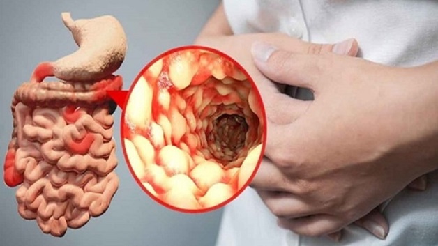 Viêm ruột là bệnh lý phổ biến ở hệ tiêu hóa