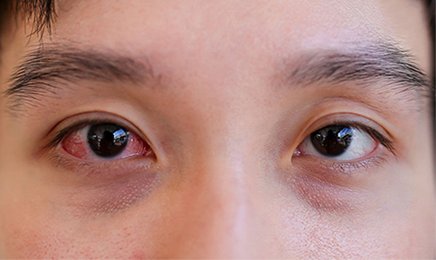 Đau mắt đỏ kiêng gì trong những ngày đầu mắc bệnh
