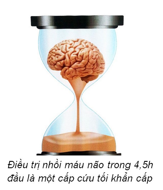 Điều trị đột quỵ nhồi máu não bằng tái tưới máu