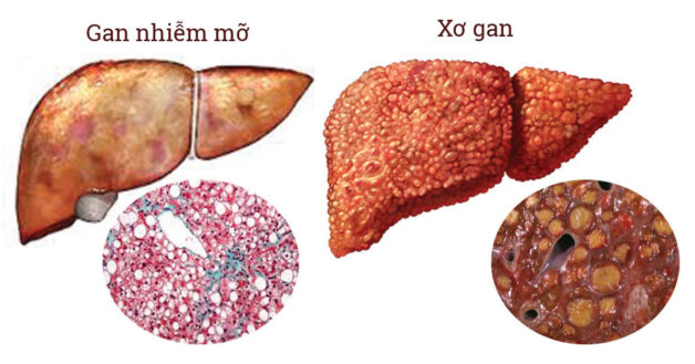 Hình ảnh biến đổi từ gan nhiễm mỡ sang xơ gan