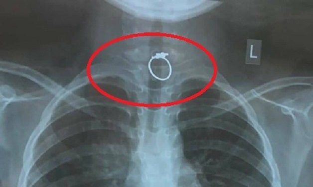 Gắp dị vật trong họng có đau không