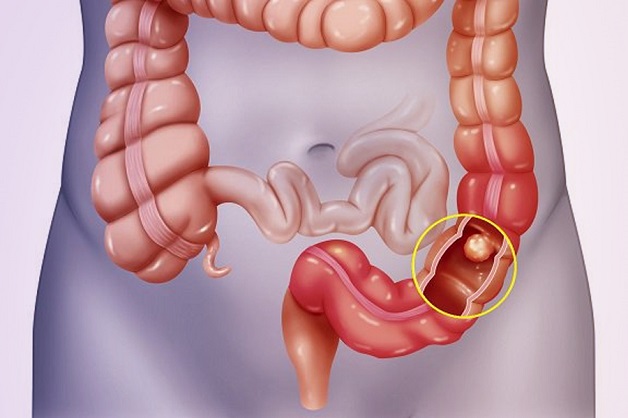 Bệnh đại tràng khá phổ biến trong xã hội hiện đại